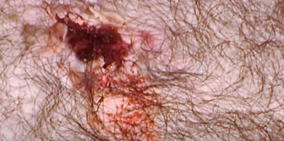 MaqPro : Maquillage d’une « Plaie soufflante au thorax »