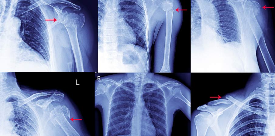 radiographie-luxation-epaule