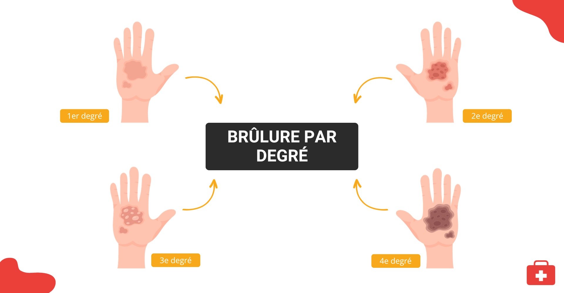 Brûlure : que faire et comment la soigner ?