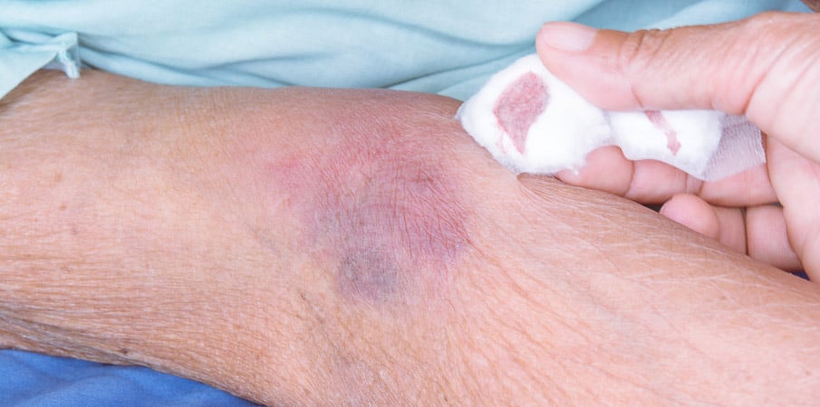 Ecchymoses : comment les traiter ?