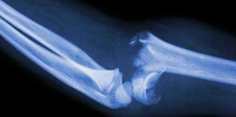 fracture os jambe tibia ouvert