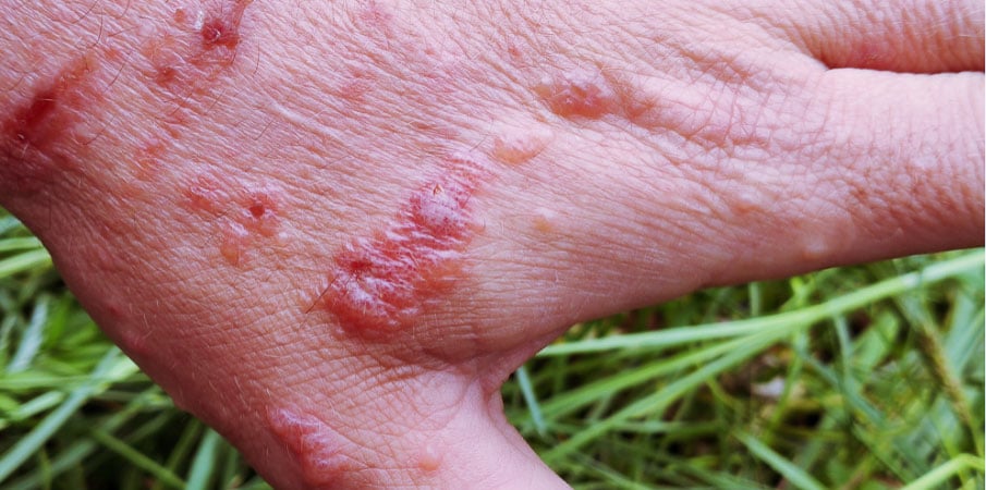 Brûlure : comment réagir et comment la soigner ?