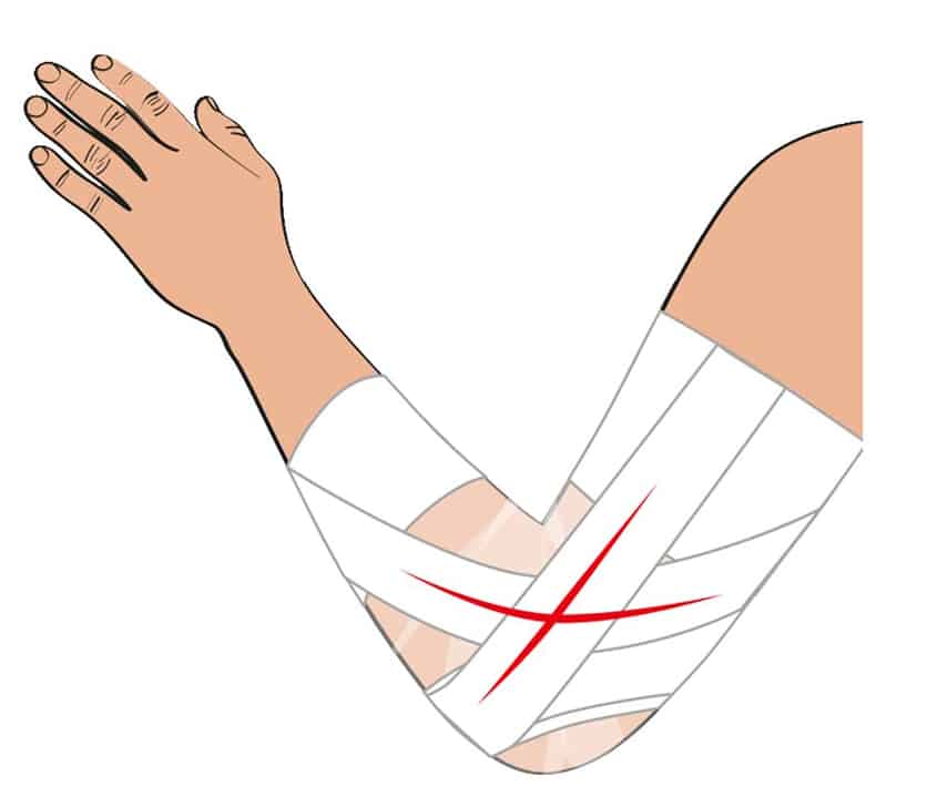 Strapping du poignet : comment le réaliser ?