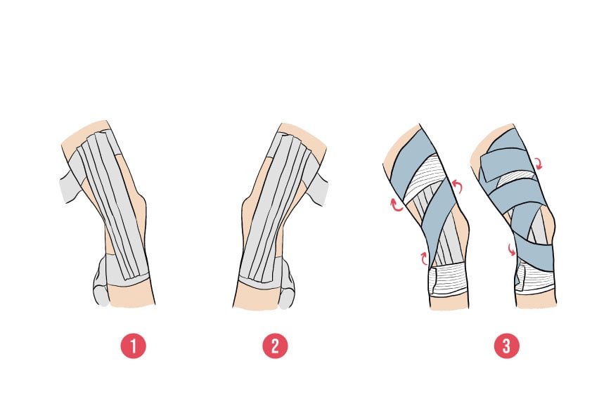 Le Strapping de genou permet de maintenir l'articulation après une lés