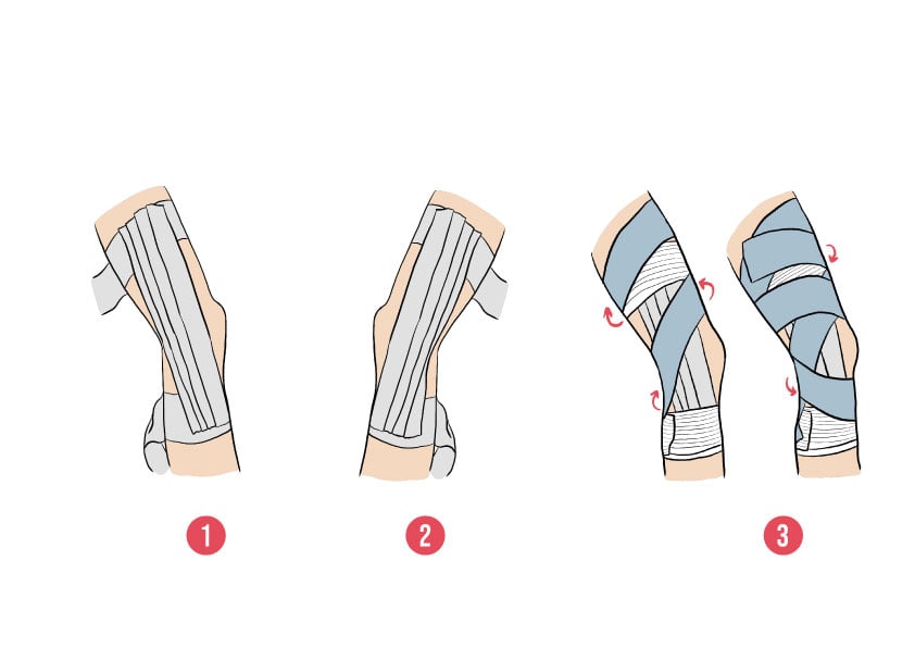 Strapping du genou : comment le réaliser ?