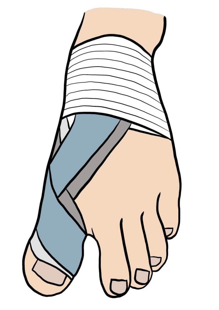 illustration strapping d'un orteil
