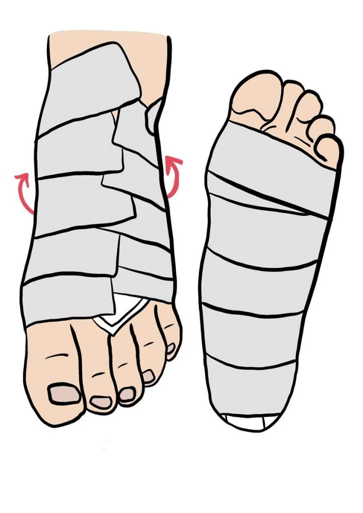 illustration d'un strapping au pied