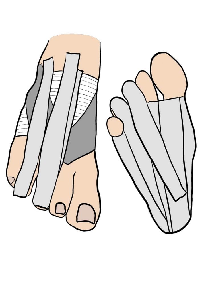 illustration strapping d'un orteil
