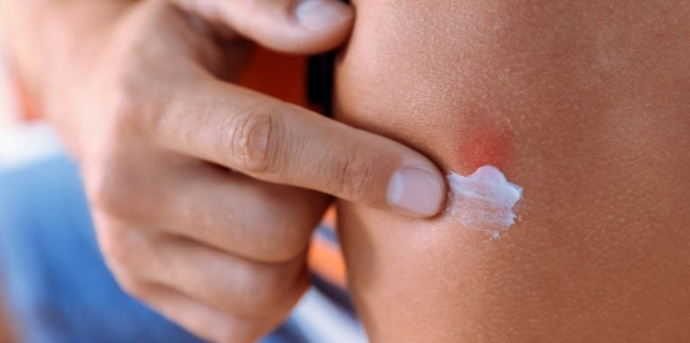 creme sur piqure de moustique