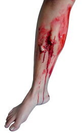 Prothèse fracture ouverte du tibia